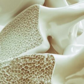 Entsäuerung - Osteoporose